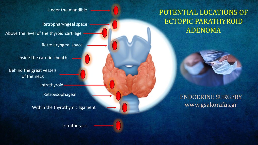 Ectopic parathyroid adenoma - clinical importance 9 0 6