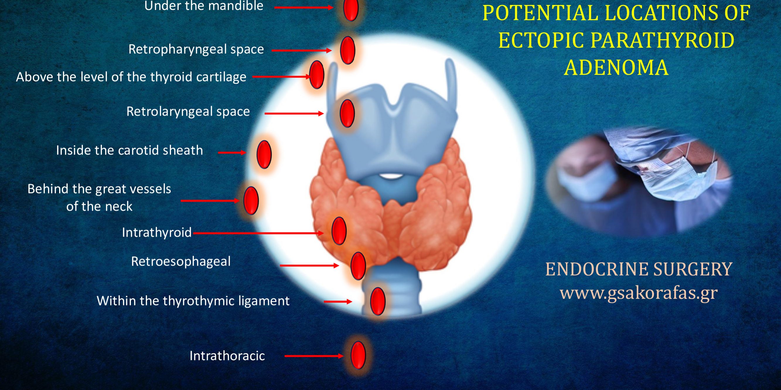 Ectopic parathyroid adenoma and embryology