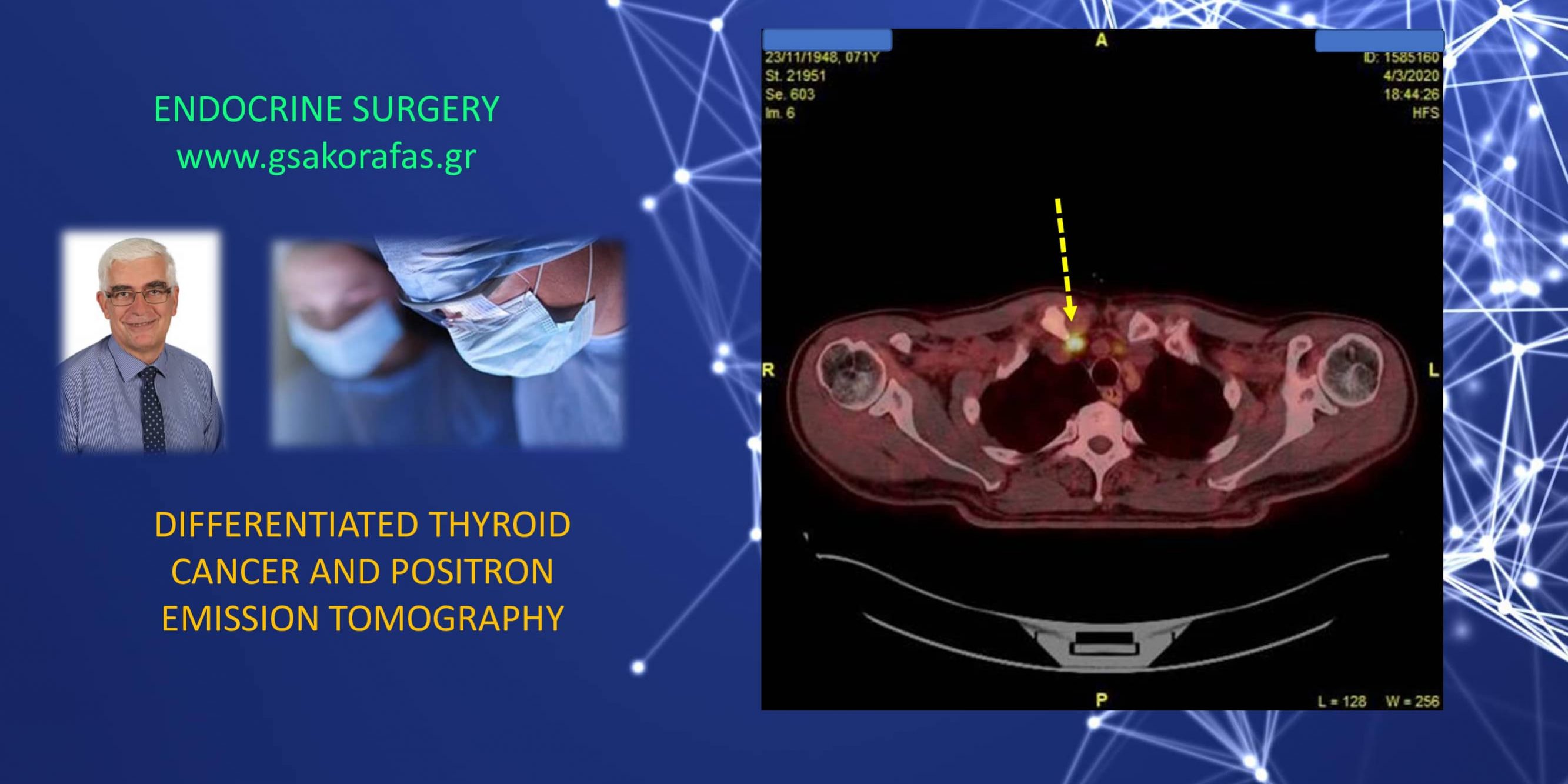 Positron emission tomography and differentiated thyroid cancer