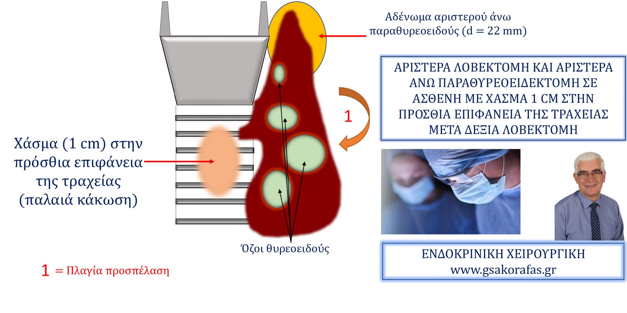 Αριστερά λοβεκτομή και αριστερά άνω παραθυρεοειδεκτομή σε ασθενή με ιστορικό κάκωσης και χάσμα της τραχείας μετά δεξιά λοβεκτομή