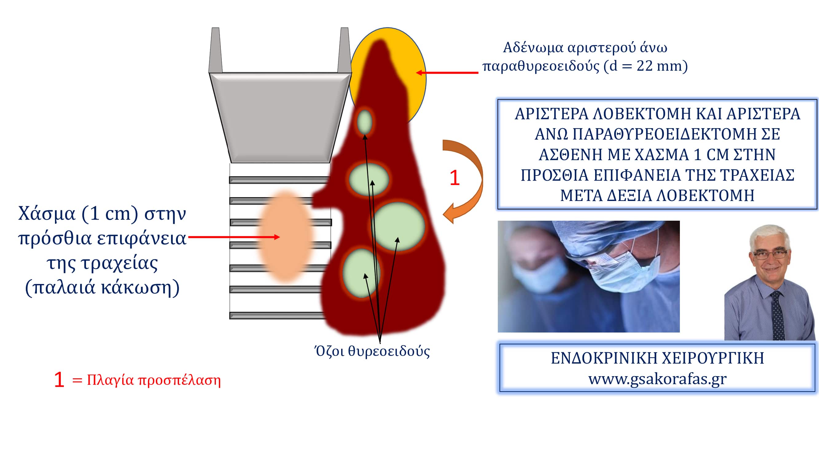 Χάσμα τραχείας, αριστερά λοβεκτομή και αριστερά άνω παραθυρεοειδεκτομή σε ασθενή με ιστορικό δεξιάς λοβεκτομής και κάκωση τραχείας