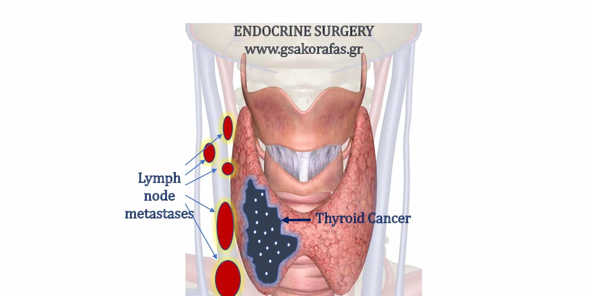 Lymph node metastases in papillary thyroid cancer - prognostic significance