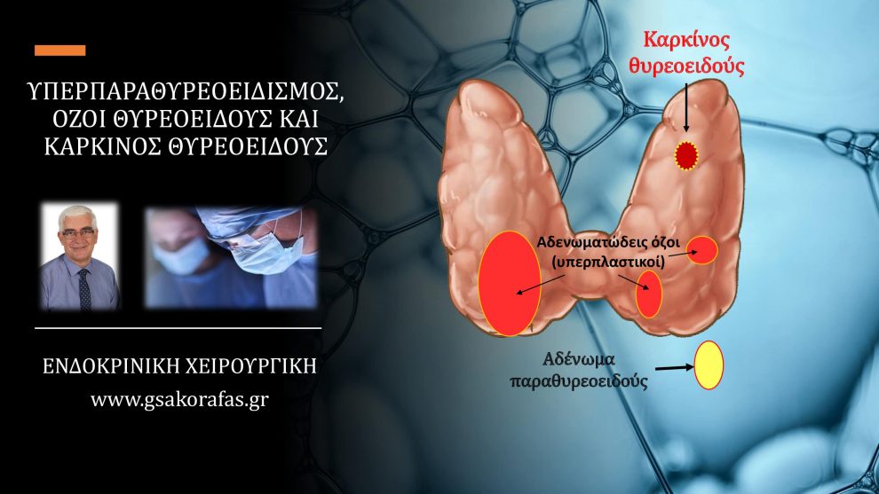 Πρωτοπαθής υπερπαραθυρεοειδισμός (αδένωμα παραθυρεοειδούς), όζος / όζοι θυρεοειδούς και καρκίνος θυρεοειδούς (συνύπαρξη στον ίδιο ασθενή) – η σημασία της σωστής προεγχειρητικής αξιολόγησης