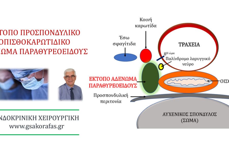 Έκτοπο αδένωμα παραθυρεοειδούς 9(προσπονδυλικό) σε ασθενή με πρωτοπαθή υπερπαραθυρεοειδισμό και υπερθυρεοειδισμό