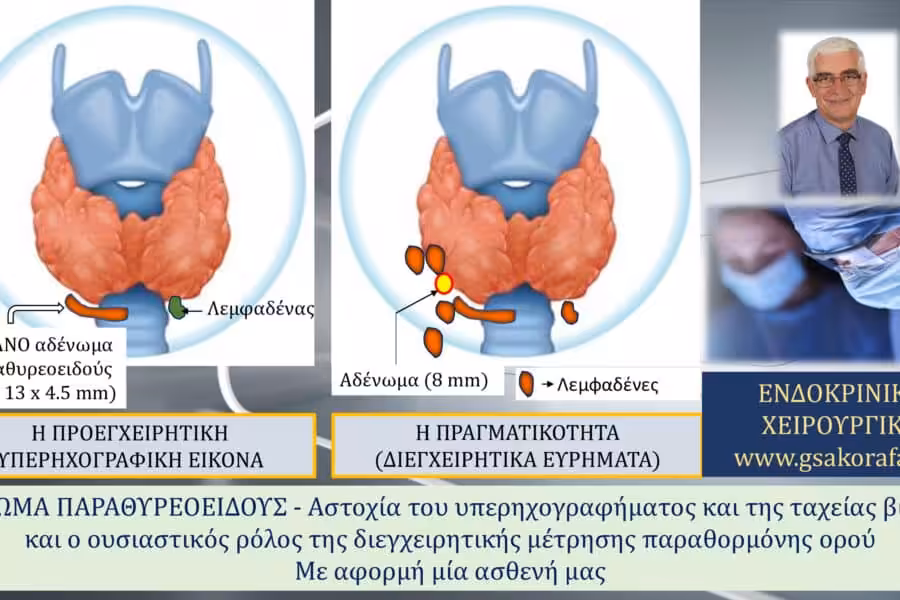 Αδένωμα παραθυρεοειδούς 6– διεγχειρητική μέτρηση παραθορμόνης και η σημασία της σε ασθενή με αστοχία του υπερηχογραφήματος και της ταχείας βιοψίας