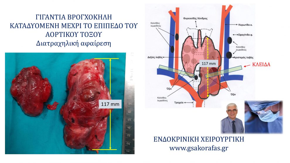 Γιγάντια καταδυόμενη βρογχοκήλη (μέχρι το ύψος του αορτικού τόξου) – αφαίρεση (ολική θυρεοειδεκτομή) μέσω τραχηλικής τομής
