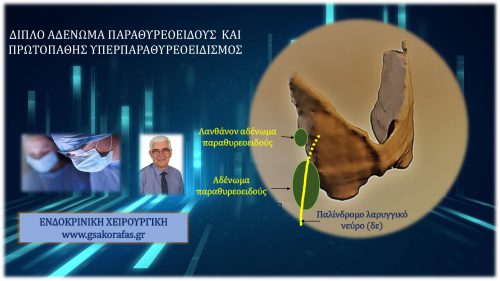 Πρωτοπαθής υπερπαραθυρεοειδισμός, διπλό (το ένα λανθάνον) αδένωμα παραθυρεοειδούς και διπλή ελάχιστα επεμβατική παραθυρεοειδεκτομή
