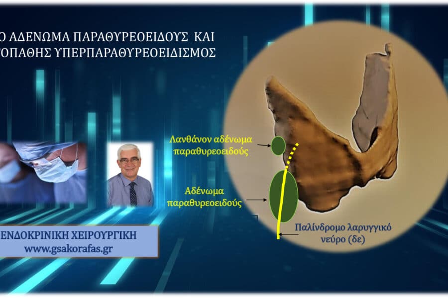 αδένωμα παραθυρεοειδούς 4, διπλό (το ένα λανθάνον) αδένωμα παραθυρεοειδούς και διπλή ελάχιστα επεμβατική παραθυρεοειδεκτομή