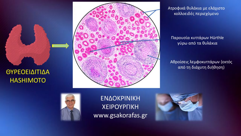 Θυρεοειδίτιδα Hashimoto-Τι είναι? Που οφείλεται? Πώς εκδηλώνεται?