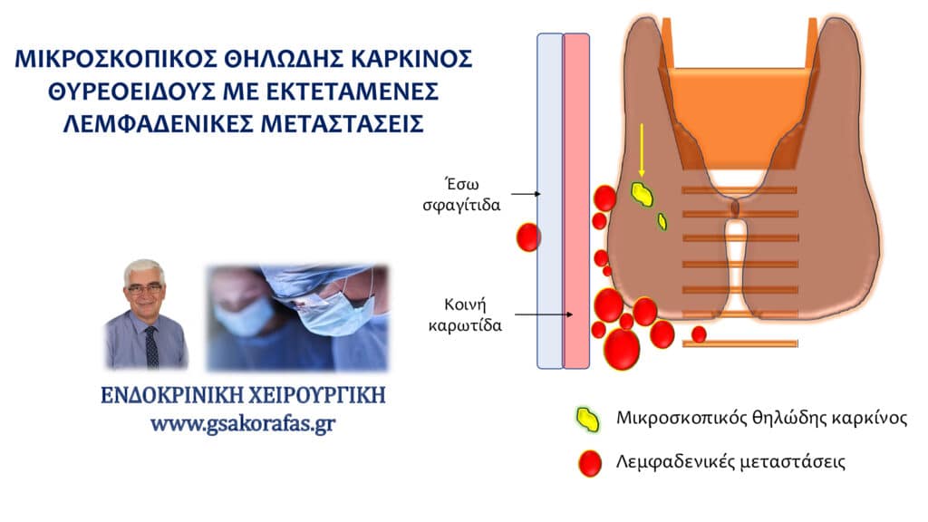 Λεμφαδενικός καθαρισμός τραχήλου σε ασθενή μας με μικροσκοπικό θηλώδη καρκίνο θυρεοειδούς και εκτεταμένες λεμφαδενικές μεταστάσεις