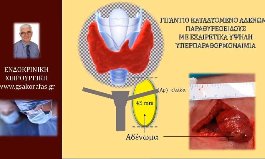 Πρωτοπαθής υπερπαραθυροειδισμός - Γιγάντιο καταδυόμενο αδένωμα παραθυρεοειδούς και εξαιρετικά υψηλή υπερπαραθορμοναιμία