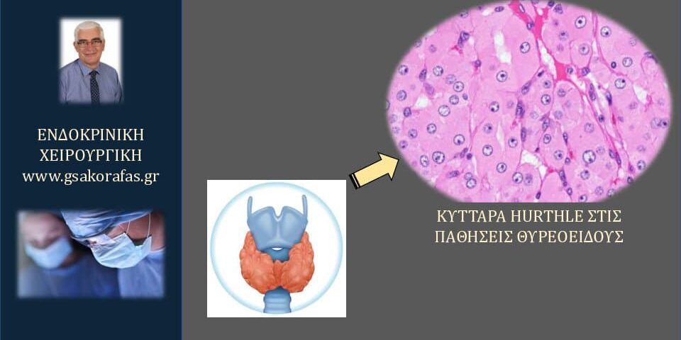 Θυρεοειδής και κύτταρα Hürthle– Τι είναι? Τι σημαίνει η παρουσία τους στις παθήσεις θυρεοειδούς?