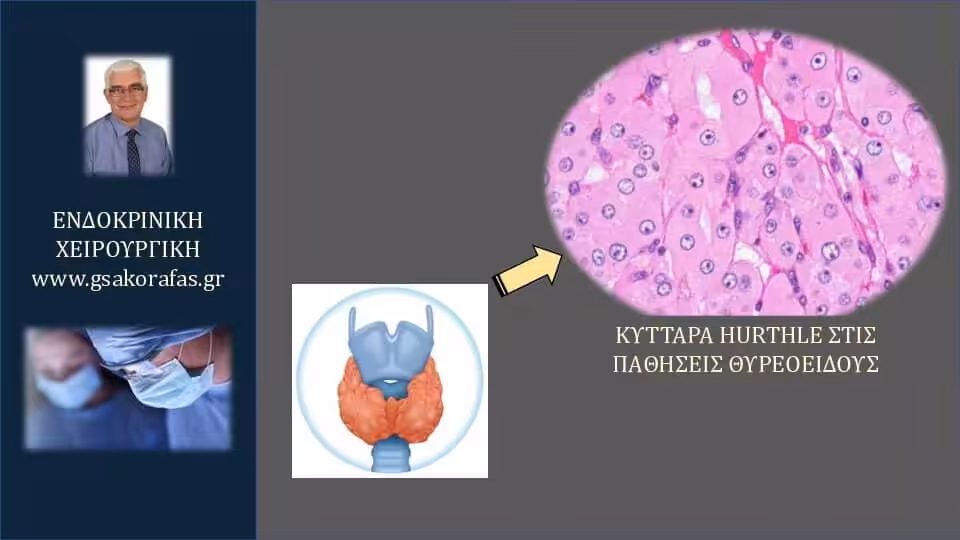 Θυρεοειδής-κύτταρα Hürthle: Τι είναι? Τι σημαίνει η παρουσία τους στις παθήσεις θυρεοειδούς?