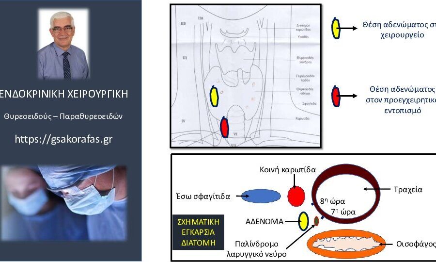 Αδένωμα παραθυρεοειδούς (οπισθοκαρωτιδικό), προεγχειρητικός εντοπισμός και επέμβαση (παραθυρεοειδεκτομή): λεπτομέρειες μεγάλης σημασίας