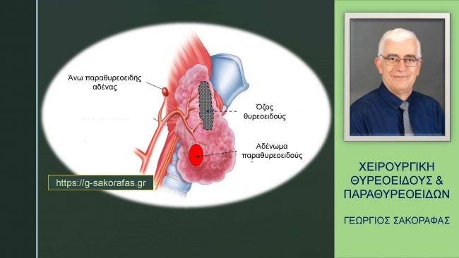 Υπερπαραθυρεοειδισμός & συνυπάρχουσα θυρεοειδοπάθεια:Ταυτόχρονη θυρεοειδεκτομή + παραθυρεοειδεκτομή