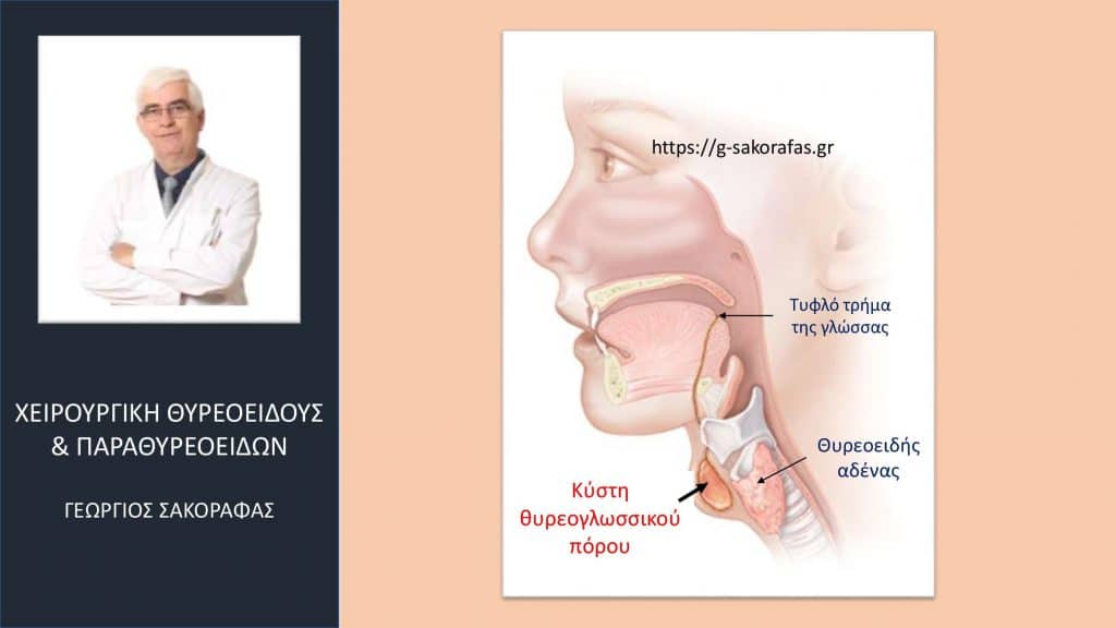 Κύστη θυρεογλωσσικού πόρου [Α]: Τι είναι? Πώς εκδηλώνεται?