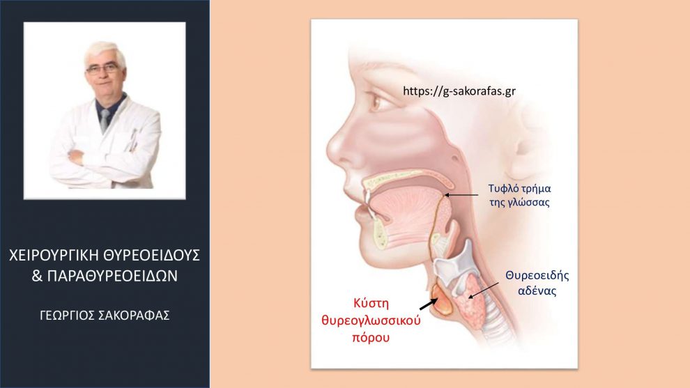 Κύστη θυρεογλωσσικού πόρου [Α]: Τι είναι? Πώς εκδηλώνεται?
