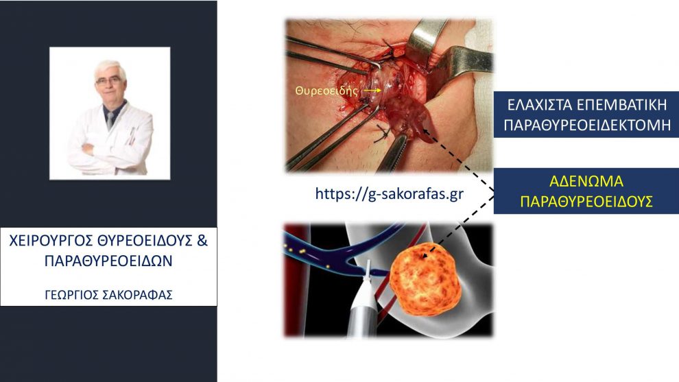 Πρωτοπαθής υπερπαραθυρεοειδισμός, ελάχιστα επεμβατική παραθυρεοειδεκτομή και μετεγχειρητική υποασβεστιαιμία-υποπαραθυρεοειδισμός