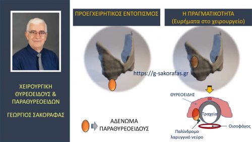 Πρωτοπαθής υπερπαραθυρεοειδισμός-διπλό αδένωμα (το ένα έκτοπο) παραθυρεοειδούς3