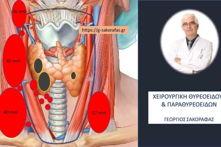 Χυλώδες συρίγγιο καρκίνος θυρεοειδούς σε ασθενή μας με αμφοτερόπλευρες λεμφαδενικές μεταστάσεις