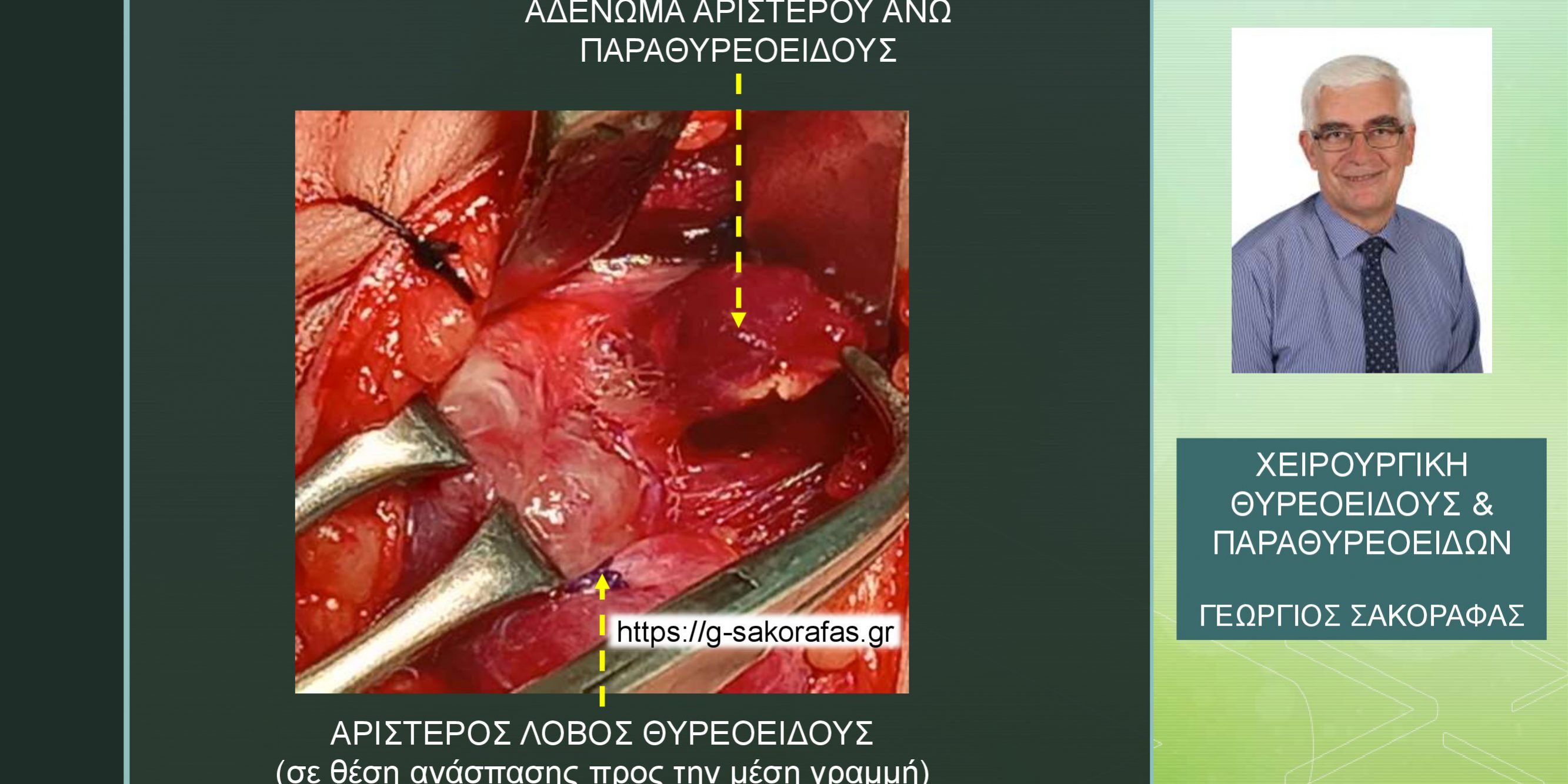 Πρωτοπαθής υπερπαραθυρεοειδισμός σε νεαρή (25 ετών) ασθενή – παραθυρεοειδεκτομή με αμφοτερόπλευρη διερεύνηση τραχήλου