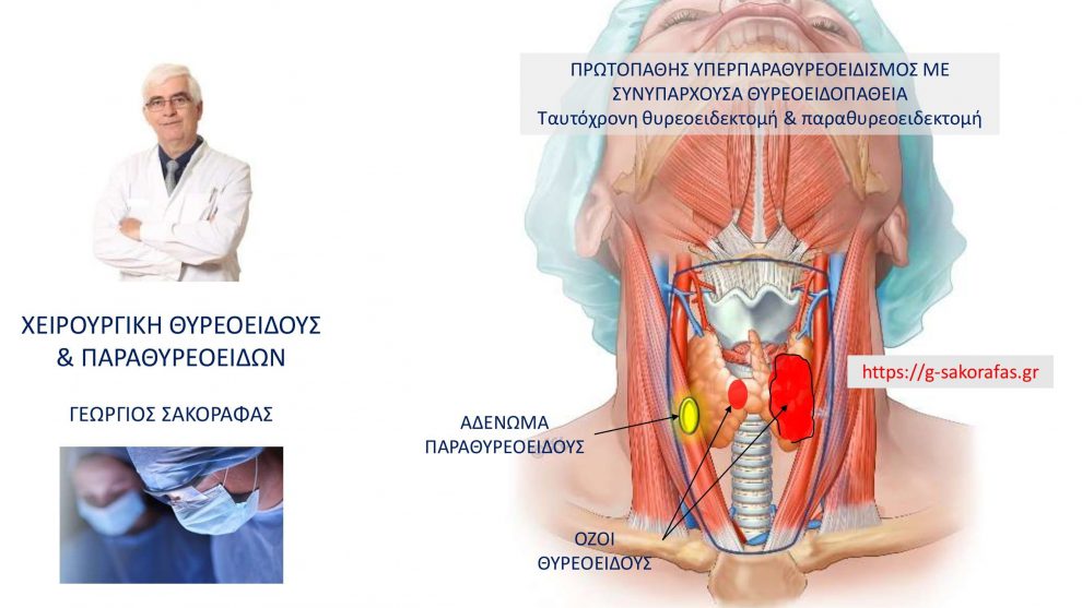 Πρωτοπαθής υπερπαραθυρεοειδισμός και όζος θυρεοειδούς – ταυτόχρονη θυρεοειδεκτομή και παραθυρεοειδεκτομή