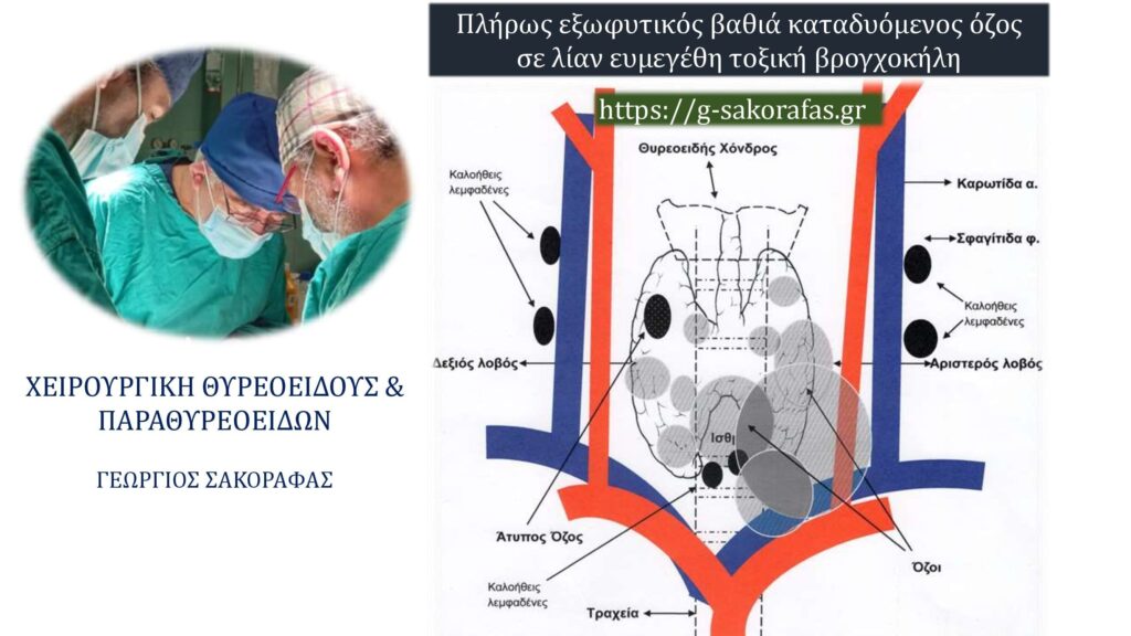 Πλήρως εξωφυτικός βαθιά καταδυόμενος όζος θυρεοειδούς σε λίαν ευμεγέθη τοξική βρογχοκήλη