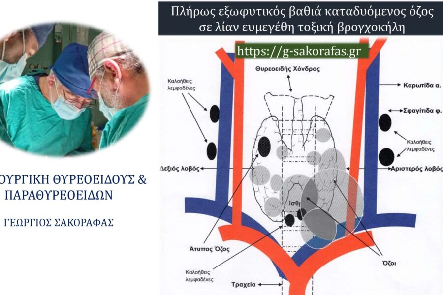 Πλήρως εξωφυτικός βαθιά καταδυόμενος όζος θυρεοειδούς σε λίαν ευμεγέθη τοξική βρογχοκήλη