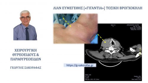 Ολική θυρεοειδεκτομή σε ασθενή με λίαν ευμεγέθη (‘γιγάντια’) τοξική βρογχοκήλη