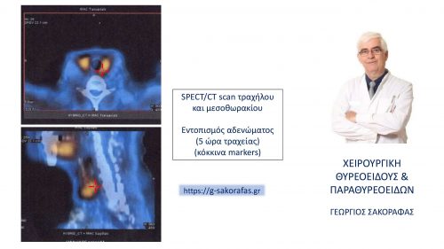 SPECT/CT-απεικόνιση του αδενώματος (κόκκινα markers)