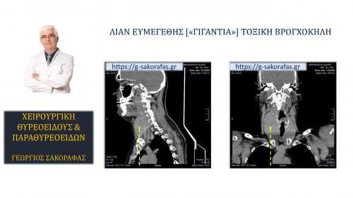 Ολική θυρεοειδεκτομή σε ασθενή με λίαν ευμεγέθη (‘γιγάντια’) τοξική βρογχοκήλη_3