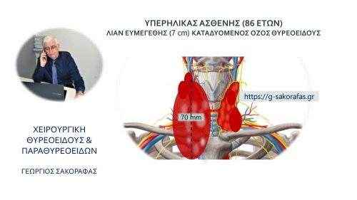 Λίαν ευμεγέθης καταδυόμενος όζος σε υπερήλικα ασθενή (86 ετών)– ασφαλής ολική θυρεοειδεκτομή μίας ημέρας νοσηλείας