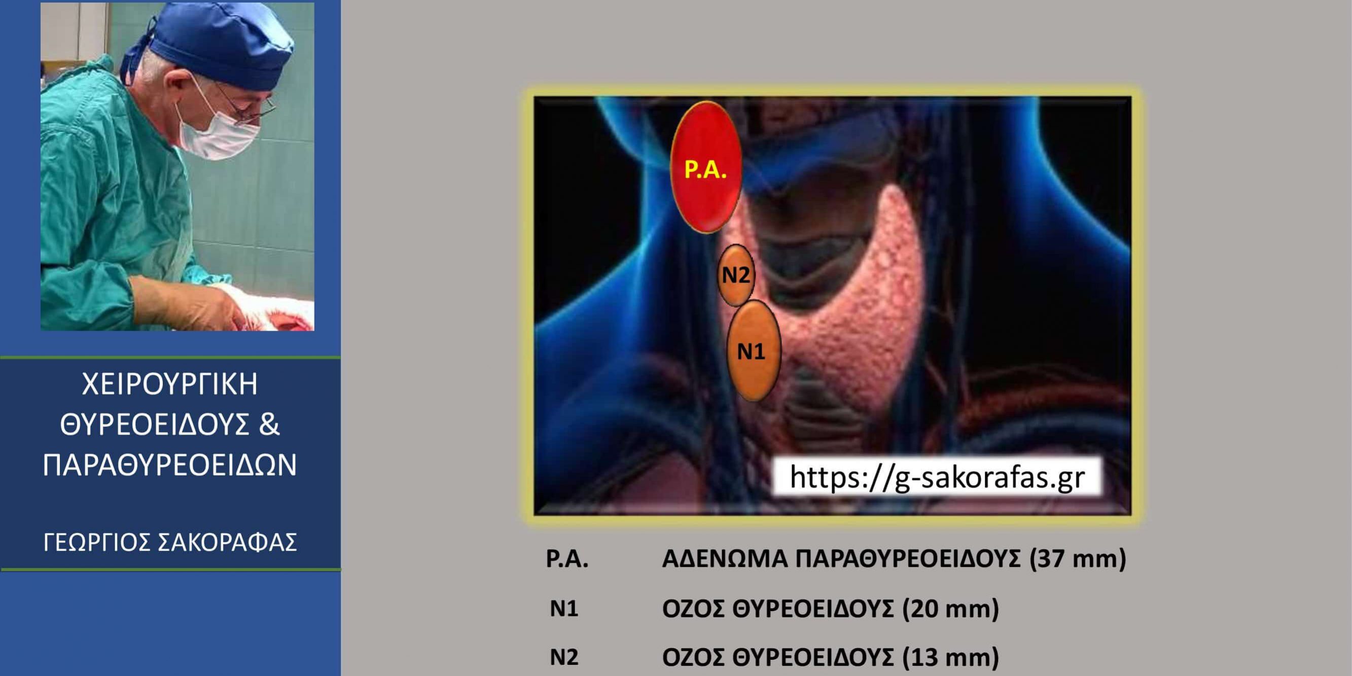 Οπισθοφαρυγγικό ευμέγεθες (37 mm) αδένωμα παραθυρεοειδούς-παραθυρεοειδεκτομή με ταυτόχρονη ολική θυρεοειδεκτομή