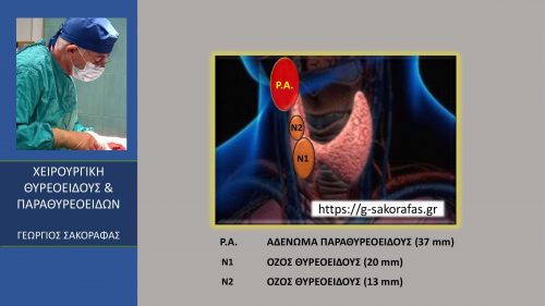 Οπισθοφαρυγγικό ευμέγεθες (37 mm) αδένωμα παραθυρεοειδούς-παραθυρεοειδεκτομή με ταυτόχρονη ολική θυρεοειδεκτομή
