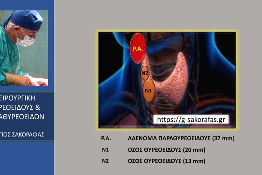θυρεοειδεκτομή παραθυρεοειδεκτομή ταυτόχρονη