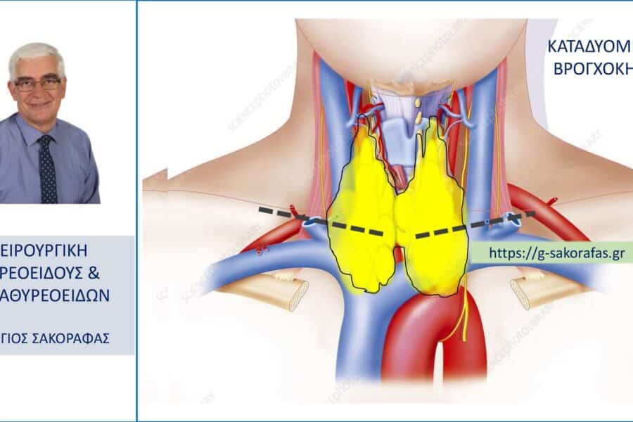 Καταδυόμενη βρογχοκήλη/καταδυόμενος όζος θυρεοειδούς – τι είναι και πώς αντιμετωπίζονται?