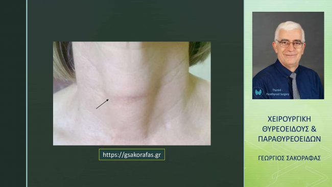 Αφαίρεση θυρεοειδούς (θυρεοειδεκτομή), χειρουργική τομή, ουλή και αισθητικό αποτέλεσμα