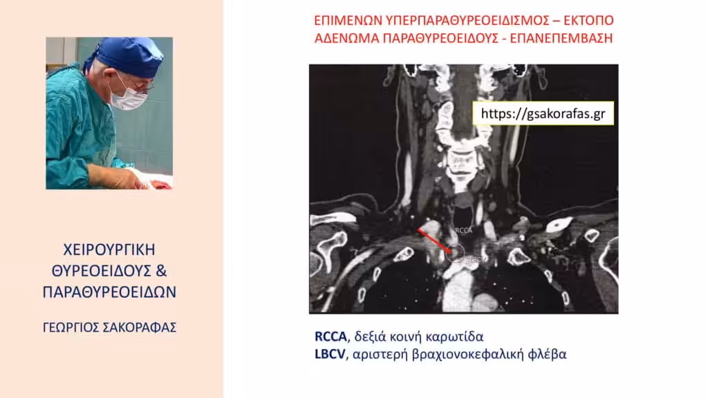 Χειρουργική Αντιμετώπιση Επιμένοντος Υπερπαραθυρεοειδισμού – Έκτοπο Αδένωμα Παραθυρεοειδούς: Εργώδης Παραθυρεοειδεκτομή (Με Αφορμή Ασθενή Μας) Χειρουργική Αντιμετώπιση Επιμένοντος Υπερπαραθυρεοειδισμού – Έκτοπο Αδένωμα Παραθυρεοειδούς: Εργώδης Παραθυρεοειδεκτομή (Με Αφορμή Ασθενή Μας)