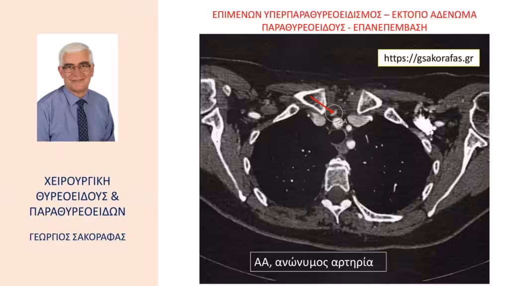 Χειρουργική Αντιμετώπιση Επιμένοντος Υπερπαραθυρεοειδισμού – Έκτοπο Αδένωμα Παραθυρεοειδούς: Εργώδης Παραθυρεοειδεκτομή (Με Αφορμή Ασθενή Μας) Χειρουργική Αντιμετώπιση Επιμένοντος Υπερπαραθυρεοειδισμού – Έκτοπο Αδένωμα Παραθυρεοειδούς: Εργώδης Παραθυρεοειδεκτομή (Με Αφορμή Ασθενή Μας)