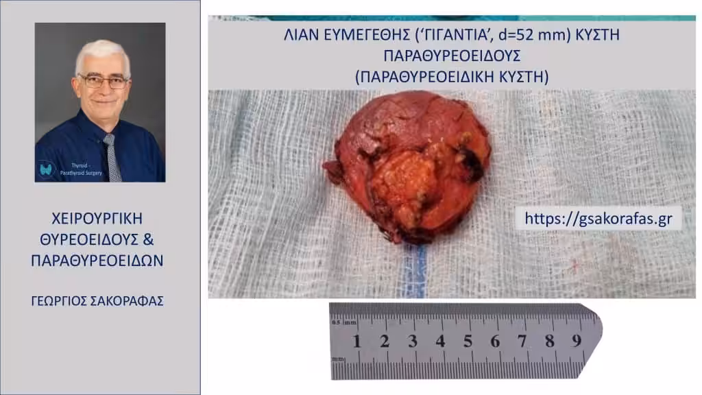 Λίαν Ευμεγέθης (‘Γιγάντια’, D = 52 Mm) Κύστη Παραθυρεοειδούς (Παραθυρεοειδική Κύστη) – Με Αφορμή Ασθενή Μας