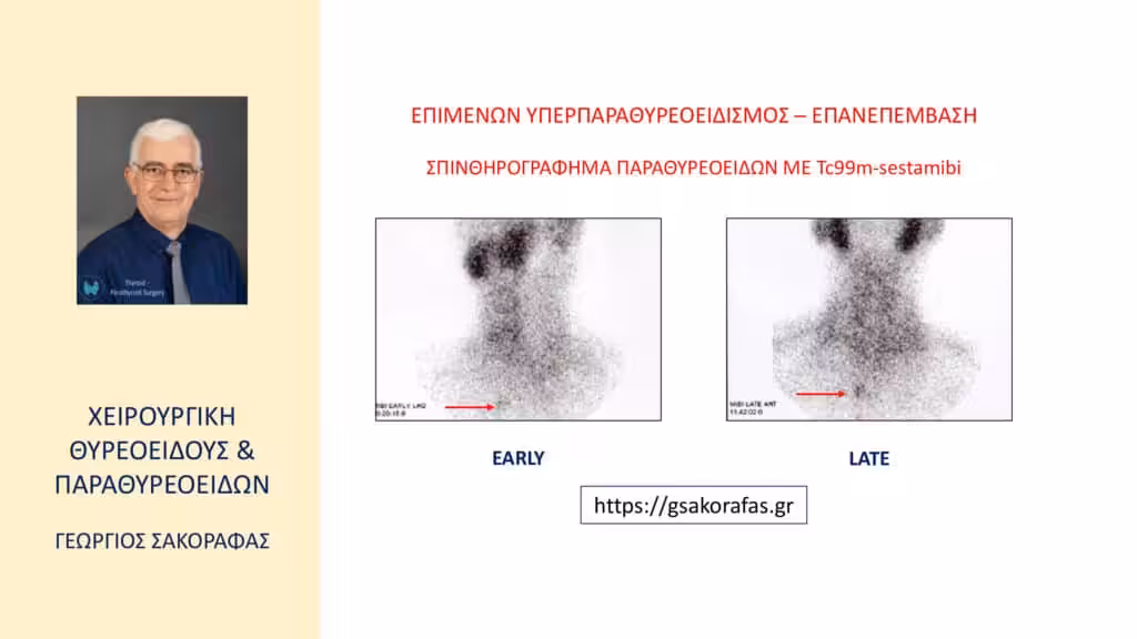 Χειρουργική Αντιμετώπιση Επιμένοντος Υπερπαραθυρεοειδισμού – Έκτοπο Αδένωμα Παραθυρεοειδούς: Εργώδης Παραθυρεοειδεκτομή (Με Αφορμή Ασθενή Μας) Χειρουργική Αντιμετώπιση Του Επιμένοντος Υπερπαραθυρεοειδισμού