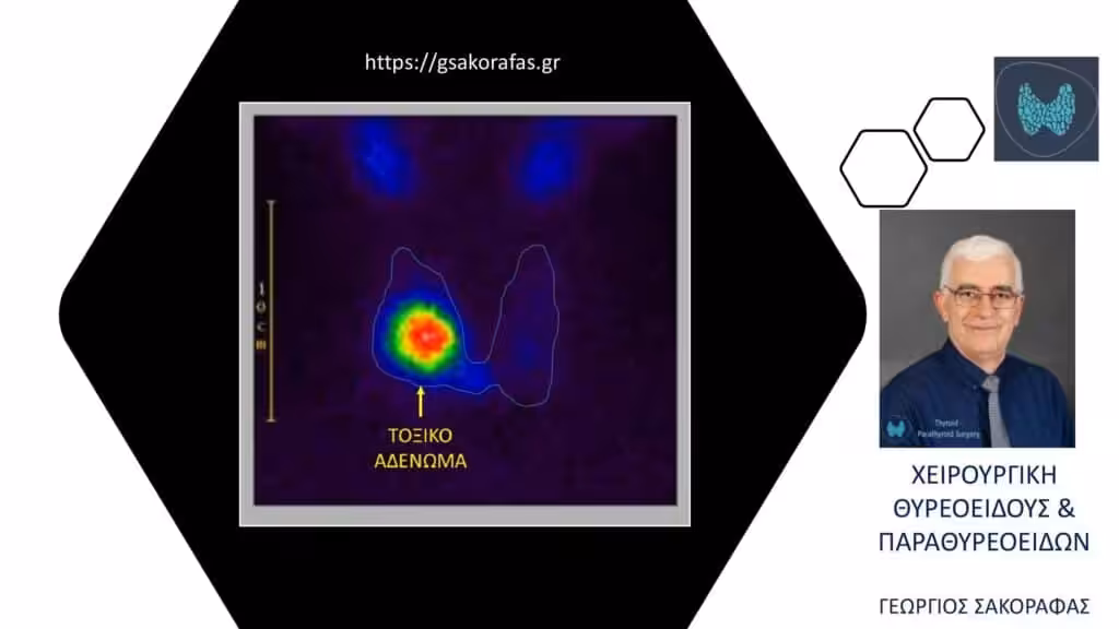 Τοξικό Αδένωμα Θυρεοειδούς – Τι Είναι? Πώς Διαγιγνώσκεται? Πώς Αντιμετωπίζεται?