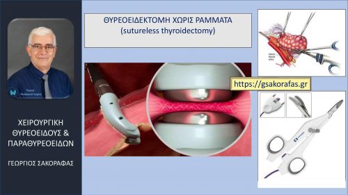 Χωρίς ράμματα θυρεοειδεκτομή (suture-less thyroidectomy)- σημαντικά μειωμένος μετεγχειρητικός πόνος (και κάποια άλλα πλεονεκτήματα)