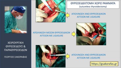Χωρίς ράμματα θυρεοειδεκτομή (suture-less thyroidectomy)