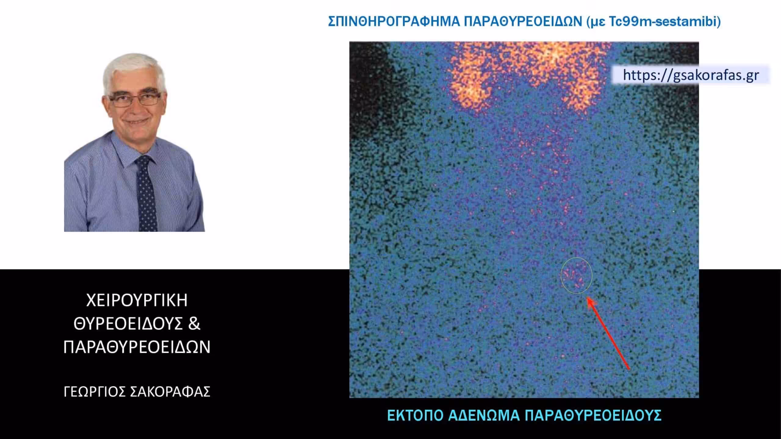 Έκτοπο Αδένωμα Παραθυρεοειδούς (Με Αφορμή Ασθενή Μας) Αδενώματα Παραθυρεοειδών