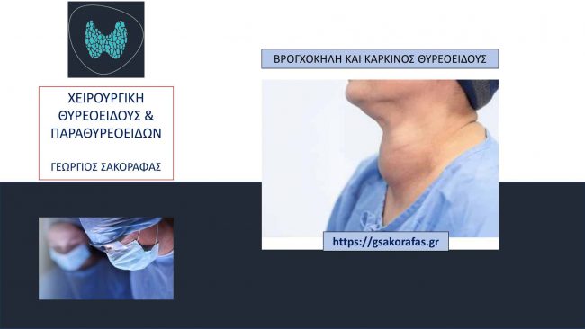 Βρογχοκήλη και καρκίνος θυρεοειδούς