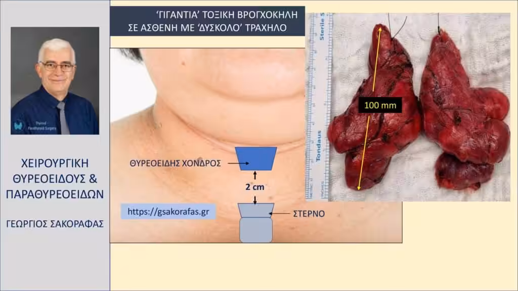 Δύσκολη Θυρεοειδεκτομή Σε Ασθενή Με Λίαν Ευμεγέθη (‘Γιγάντια’) Τοξική Βρογχοκήλη Και ‘Δύσκολο’ Τράχηλο Δύσκολη Θυρεοειδεκτομή Σε Ασθενή Με Γιγάντια Τοξική Βρογχοκήλη Και Δύσκολο Τράχηλο
