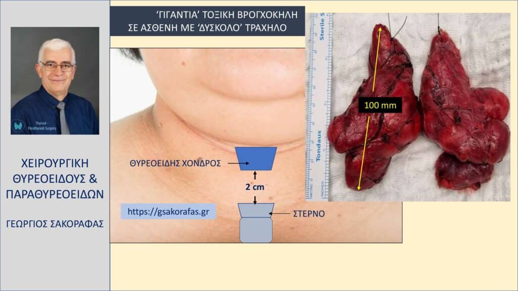 Δύσκολη θυρεοειδεκτομή σε ασθενή με γιγάντια τοξική βρογχοκήλη και δύσκολο τράχηλο
