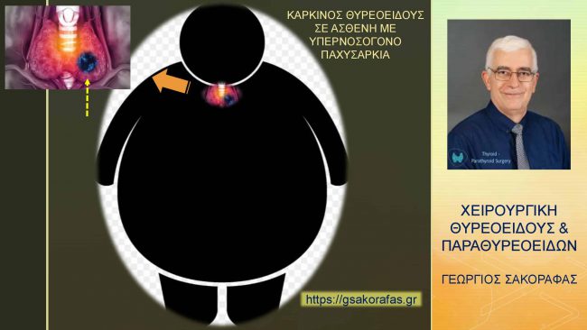 Καρκίνος θυρεοειδούς – θυρεοειδεκτομή σε ασθενή μας με νοσογόνο παχυσαρκία: προβλήματα – ιδιαιτερότητες – πρακτική σημασία