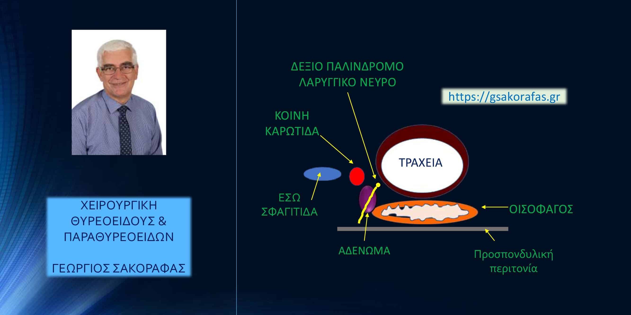 Αδένωμα παραθυρεοειδούς σε έκτοπη θέση (βαθιά οπισθοκαρωτιδικά, στον προσπονδυλικό χώρο) – με αφορμή ασθενή μας